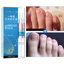 Spot a bright biological repair film to remove onychomycosis nail biological repair liquid to correct onychomycosis