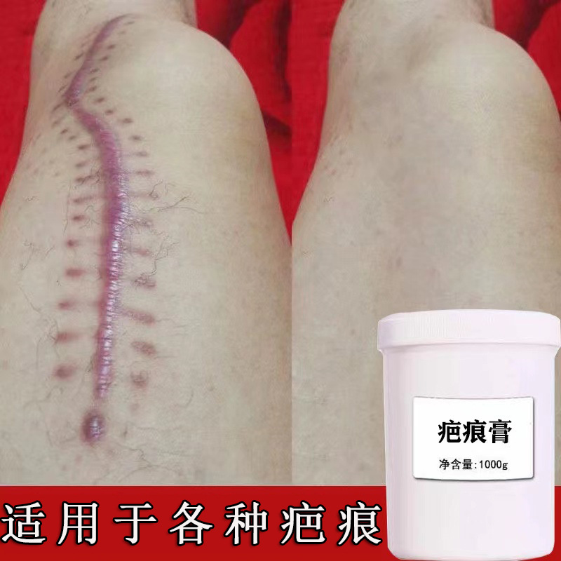 Scar Repair Cream Anti-scar cream fade old scar after operation scar removing acne marks acne pit beauty salon scar cream